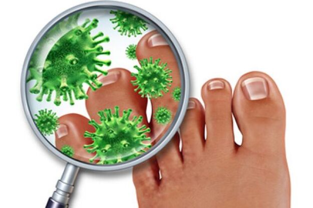 fungal infections of toenails
