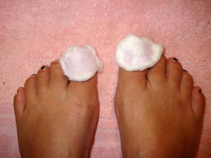 lotion for fungus on the feet