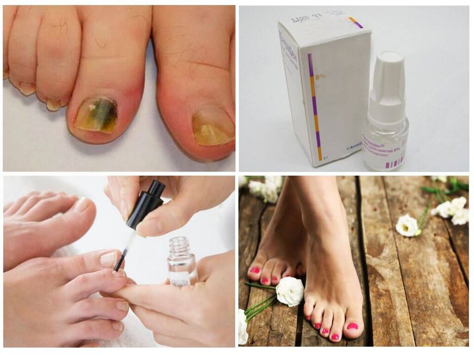 how to use polish against nail fungus