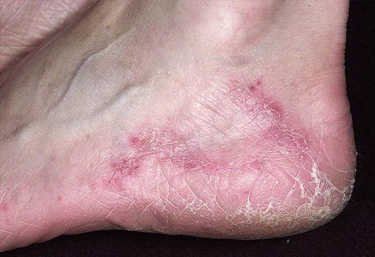 Cracks and redness on the skin of the heel are signs of a fungal infection