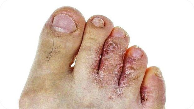How does toenail fungus appear 