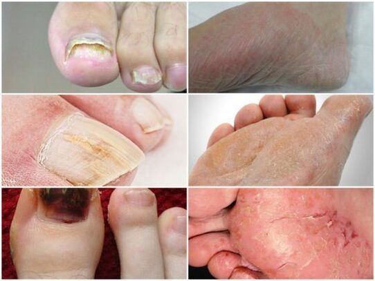 what does mycosis look like on the feet