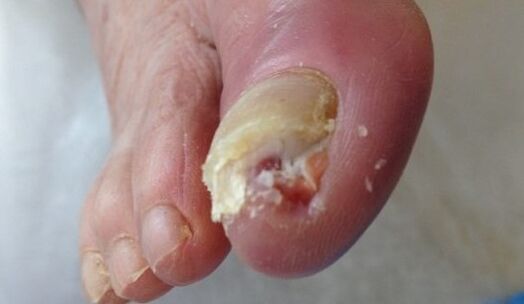 Nails that hurt