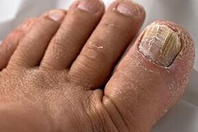 Nail fungus photos