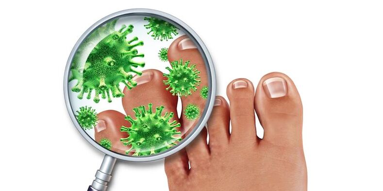 Nails infected with fungus