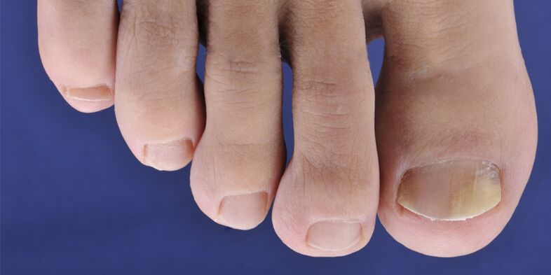 Symptoms of skin mycosis and nail plate
