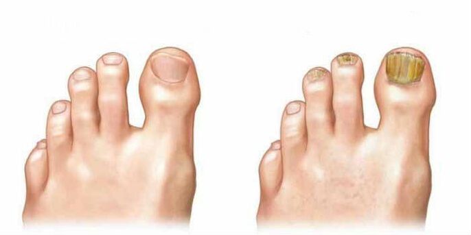 Like what fungus on nails