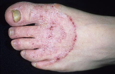 The foot and nails fungus