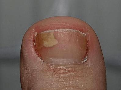 fungus on the left side of the nails