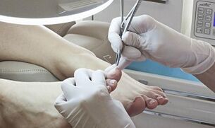 Nail surgery with the presence of a fungus