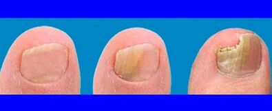 Stage of fungal development in the toes