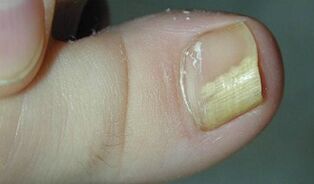 The signs and symptoms of nail fungus