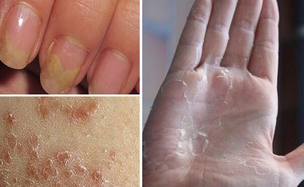 Can mycosis turn to other parts of the body