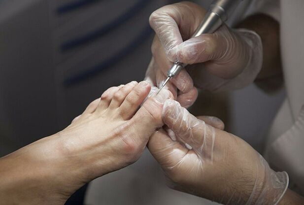 Diagnosis of foot fungus