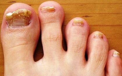 toenail fungus