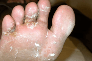 Fungus on fingers and toes