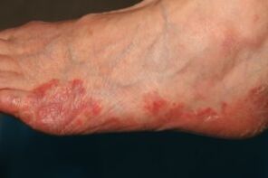 fungal manifestations on the feet