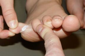 toe fungus