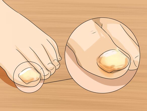 Fungus on the big toe