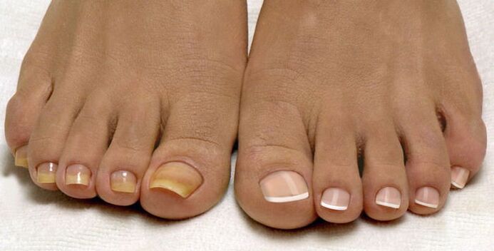 toenails and healthy nails affected by fungus