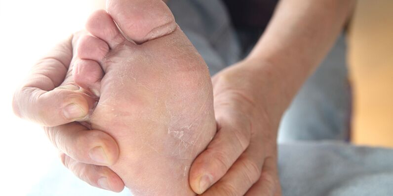 skin lesions with fungus on the feet