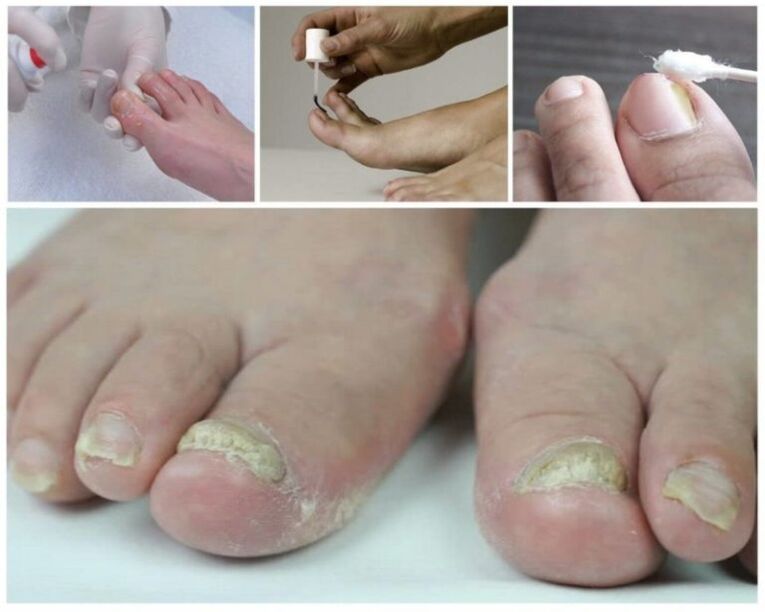 remedy for toenail fungus