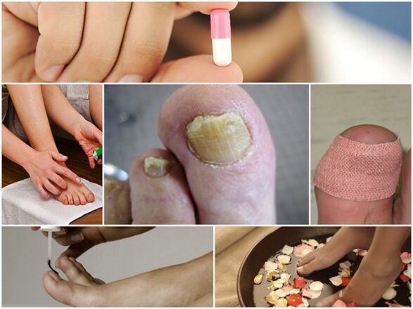 type of remedy for toenail fungus