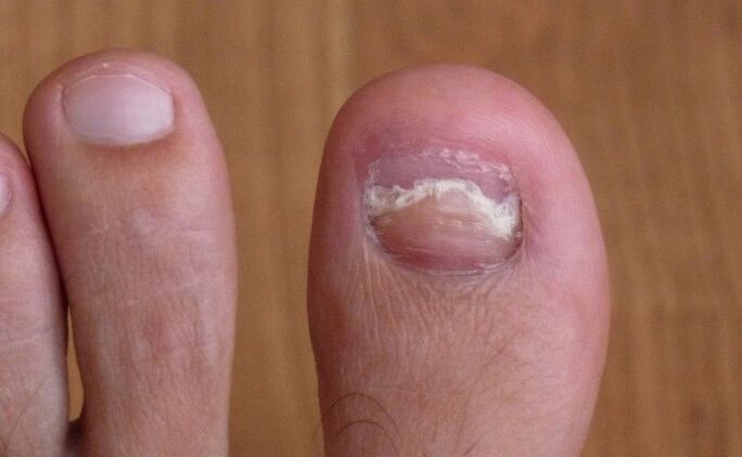 damage to the nails on the big toes with fungus
