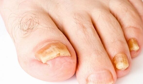 pictures of toenail fungus symptoms