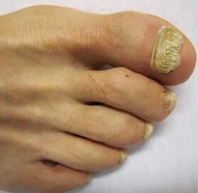 advanced stages of toenail fungus
