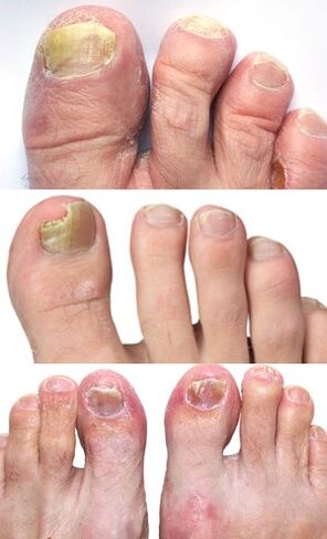 pictures of toenail fungus