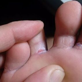 cracks between toe fungus symptoms